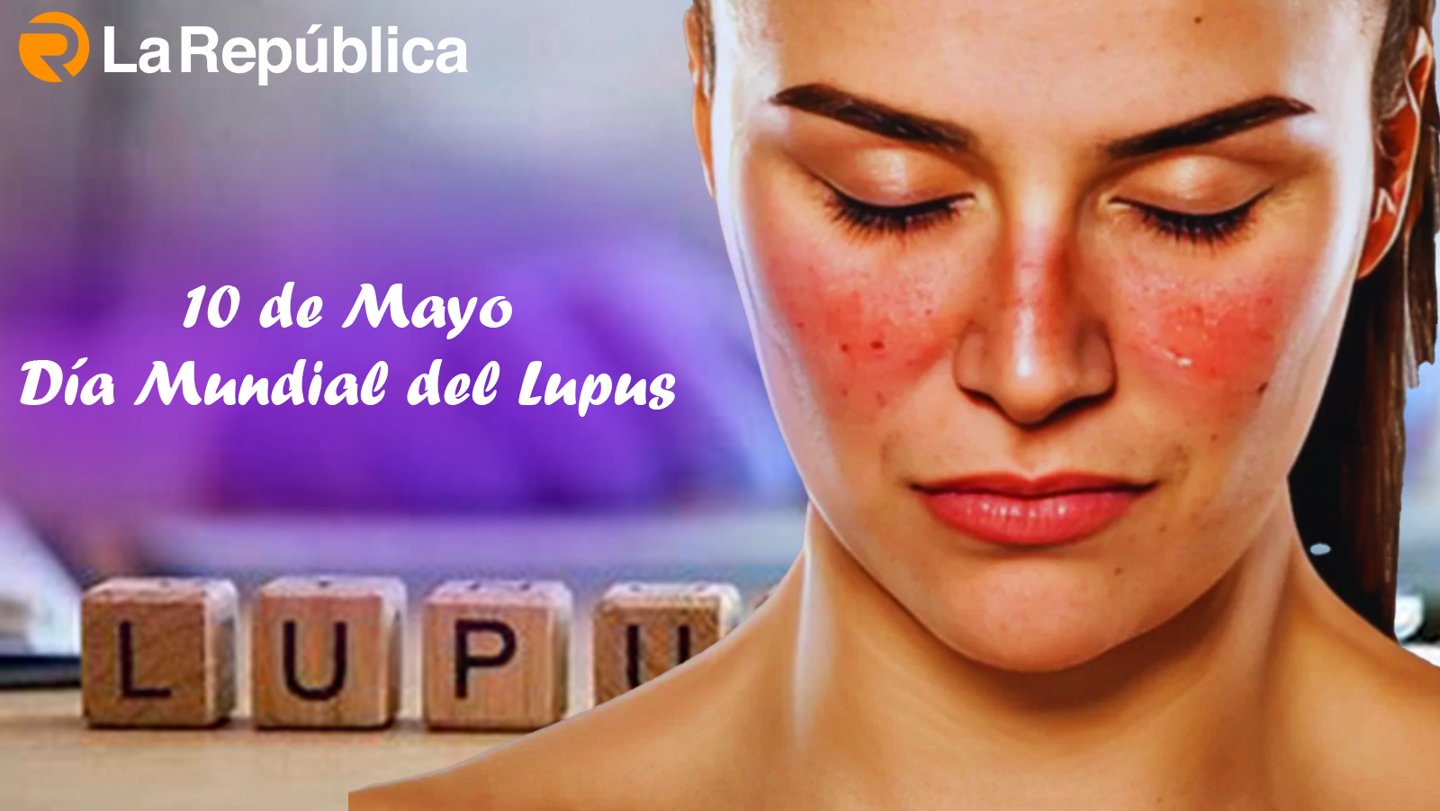 10 de Mayo, Día Mundial del Lupus - Cover Image